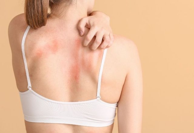 swędzące ślady na ciele